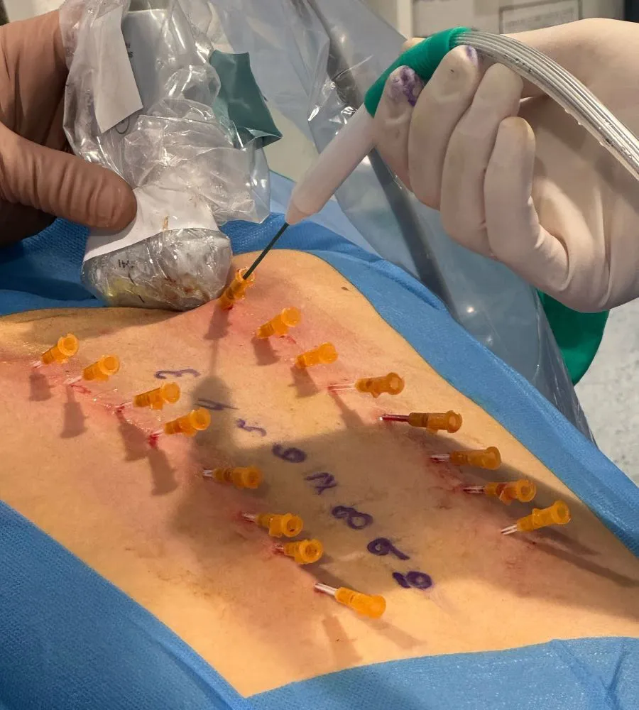 Crioanalgesia Quirónsalud Málaga