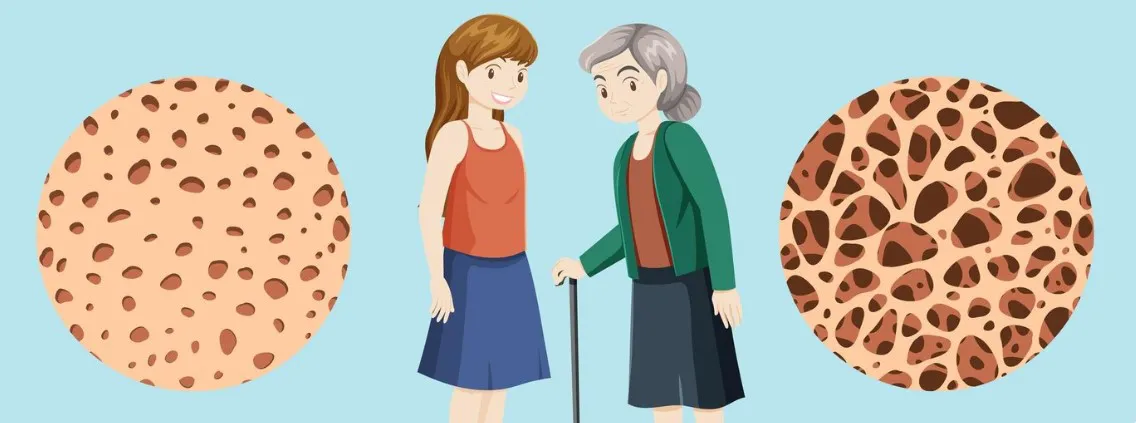 imagen freepik_osteoporosis